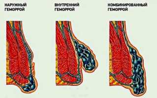 Классификация геморроя и особенности лечения каждого его вида