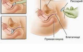 Правила ношения гинекологического кольца при опущении матки, плюсы и минусы