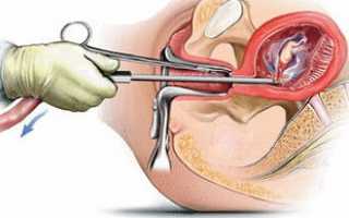 Особенности проведения вакуумной аспирации (мини-аборта) и ее влияние на менструальный цикл