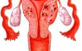 Что такое аденомиоз матки, признаки, причины возникновения и как его лечить