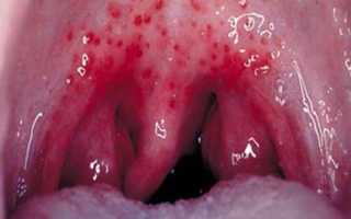 Герпетическая ангина у детей
