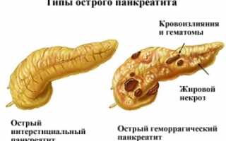 Диагностика и лечение заболеваний и болей в поджелудочной железе