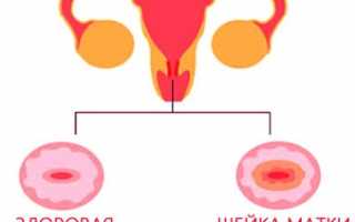 Все про эрозию шейки матки: симптомы, причины, прижигание, народные методы лечения, влияние на месячные и беременность