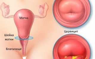 Цервицит у женщин — признаки и особенности лечения