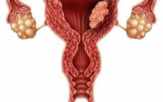 Аденокарцинома матки: высокодифференцированная, умеренно дифференцированная, низкодифференцированная