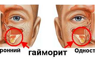 Двухсторонний гайморит