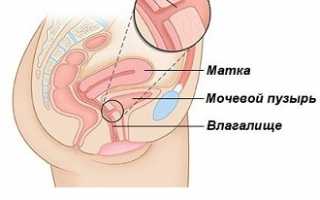 Симптомы и лечение свища во влагалище, как он выглядит, прогноз и профилактика