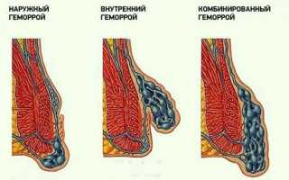 Симптомы и методы лечения наружного (внешнего) геморроя с фото