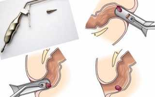 Техника проведения лигирования геморроидального узла латексными кольцами (с ценами и отзывами)