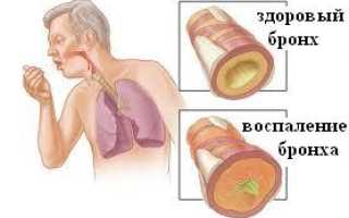 Лечение хронического бронхита — обострения