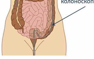 Особенности проведения колоноскопии при месячных и беременности