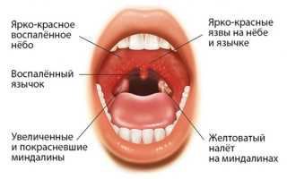 Сколько держится температура при ангине у ребенка