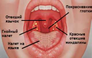 Фолликулярная ангина