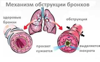 Обструктивный бронхит — что это такое и как лечить