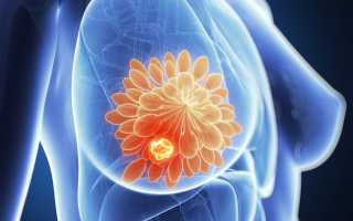 Мастопатия в период менопаузы: причины, лечение, риск заболевания раком