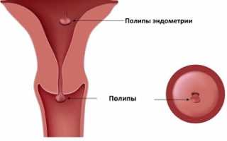 Полип в эндометрии матки: 4 вида, 5 причин возникновения, 3 способа лечения