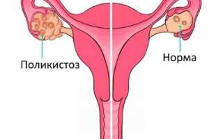 Фитотерапия при поликистозе яичников