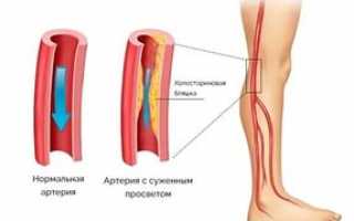 Диабетическая ангиопатия — как повышенный сахар влияет на сосуды?