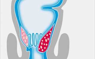 Как выглядят проявления геморроя на фото в разных стадиях