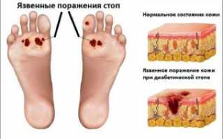 Полинейропатия нижних конечностей – осложнение сахарного диабета