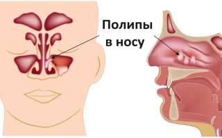 Причины, симптомы появления полипов в носу, методы лечения