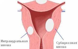 Как лечить интрамуральную миому матки