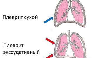 Что такое плеврит легких и его лечение