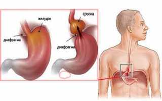 Причины возникновения грыжи пищевода, как определить и лечить болезнь