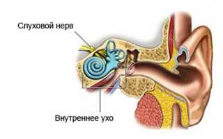 Неврит слухового нерва