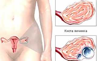 Причины, симптомы и лечение гормональной кисты яичника