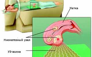 Лечение миомы матки с помощью ФУЗ-абляции (фокусированного ультразвука)