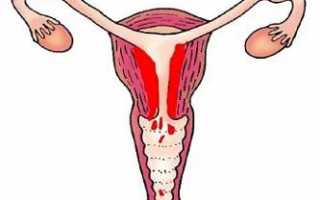 Причины и лечение метроррагии, или маточного кровотечения