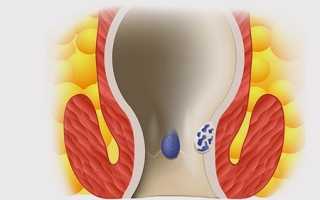 Какая симптоматика и как лечить внутренний геморрой (с фото)
