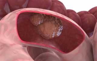 Характерные признаки опухолей кишечника и особенности терапии