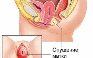 Симптомы и степени выпадения матки, как лечить опущение матки, пессарий, препараты, операция, гимнастические упражнения