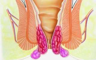 Симптоматика геморроя 3 стадии и как лечить заболевание