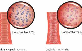 Симптомы бактериального вагиноза, чем лечить, особенности болезни при беременности