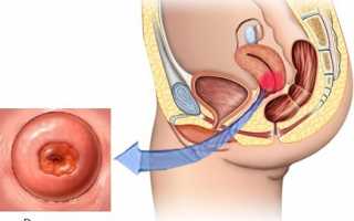 Эктропион шейки матки — в чем опасность, как лечить