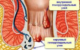 Что делать, если вылез геморрой (как лечить)