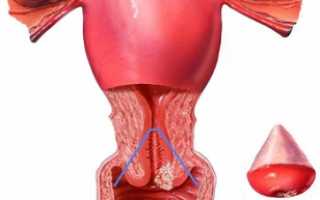 Что такое конизация шейки матки, в чем особенности восстановления после этой операции