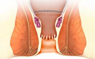 Как проявляется начальная стадия геморроя (фото) и методы лечения