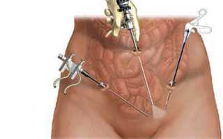 Как проводится лапароскопия при эндометриозе, можно ли забеременеть после операции