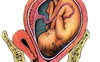 Миома матки во время беременности: влияние на зачатие, можно ли рожать