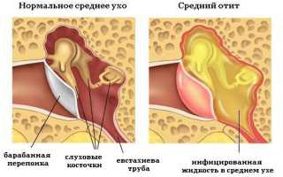 Отит (воспаление) среднего уха — что это и как лечить