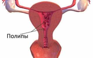 Причины, симптомы и способы удаления полипов в матке