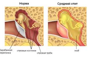 Чем опасен для здоровья отит среднего уха