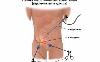 Ход проведения лапароскопии аппендицита (с ценами)