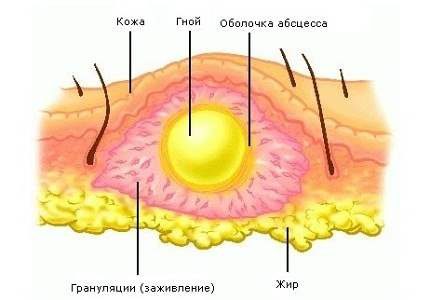 Абсцесс бартолиновой железы