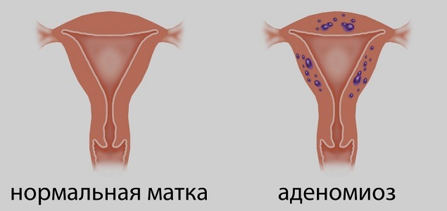 Аденомиоз матки