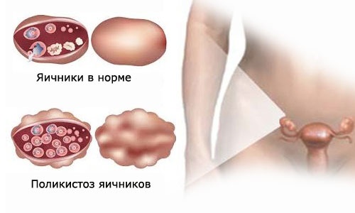 Апоплексия при поликистозе яичника